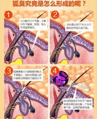 腋下狐臭知多少 告诉你哪些方法去腋臭最佳