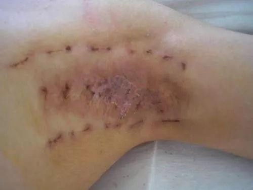 治狐臭的常见误区 为何越掩盖越严重？