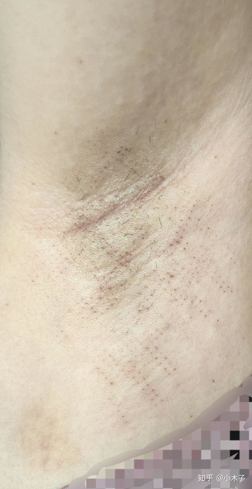 成都腋臭治疗医院真实推荐与注意事项