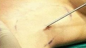 手术治疗狐臭疼吗？了解狐臭与腋臭的治疗过程