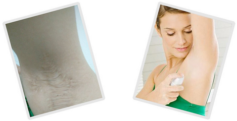 美国miraDry腋臭净化术进驻北京，为狐臭困扰带来创新解决方案